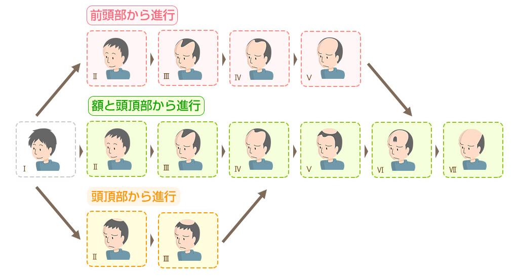 男性の薄毛の進行タイプ