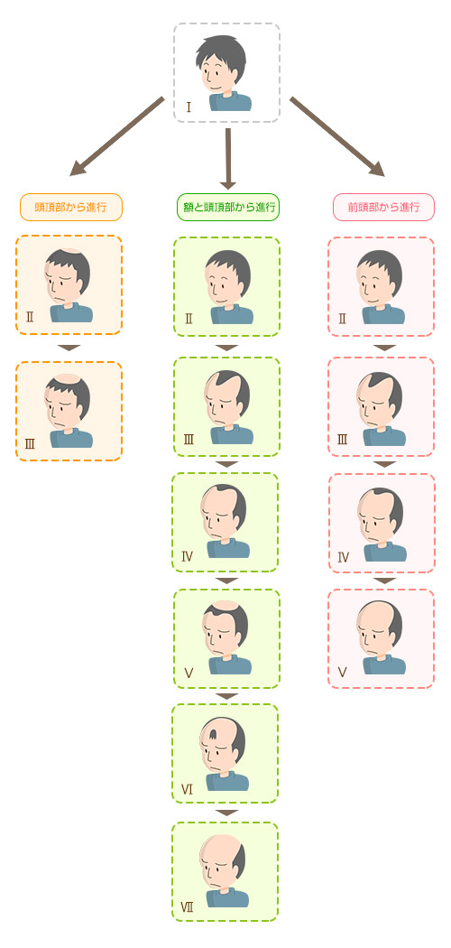男性の薄毛の進行タイプ